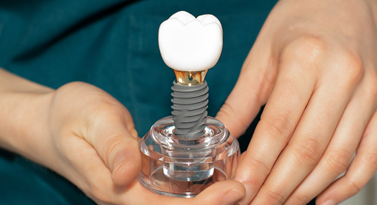 Straumann Implants: Swiss Precision and Excellence in Implant Dentistry