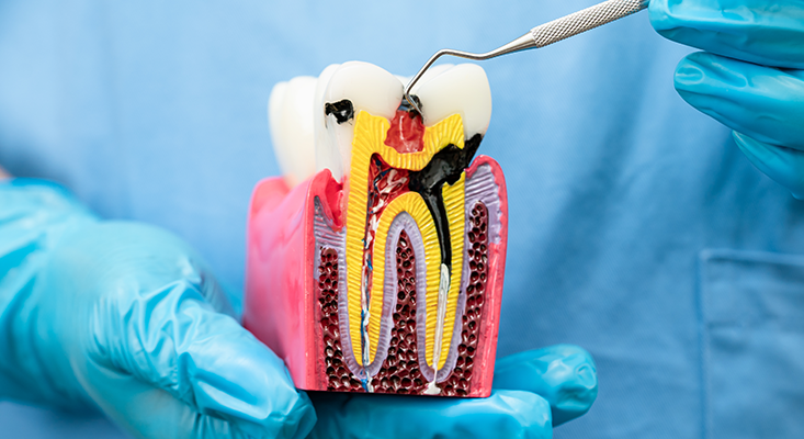 Root Canal for 1 Root, 2 Root, and 3 Root Teeth: What Patients Need to Know